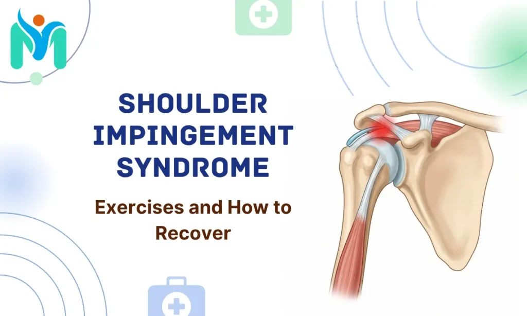 Medical illustration showing subacromial space inflammation and compressed supraspinatus tendon in shoulder impingement syndrome.