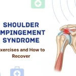 Medical illustration showing subacromial space inflammation and compressed supraspinatus tendon in shoulder impingement syndrome.
