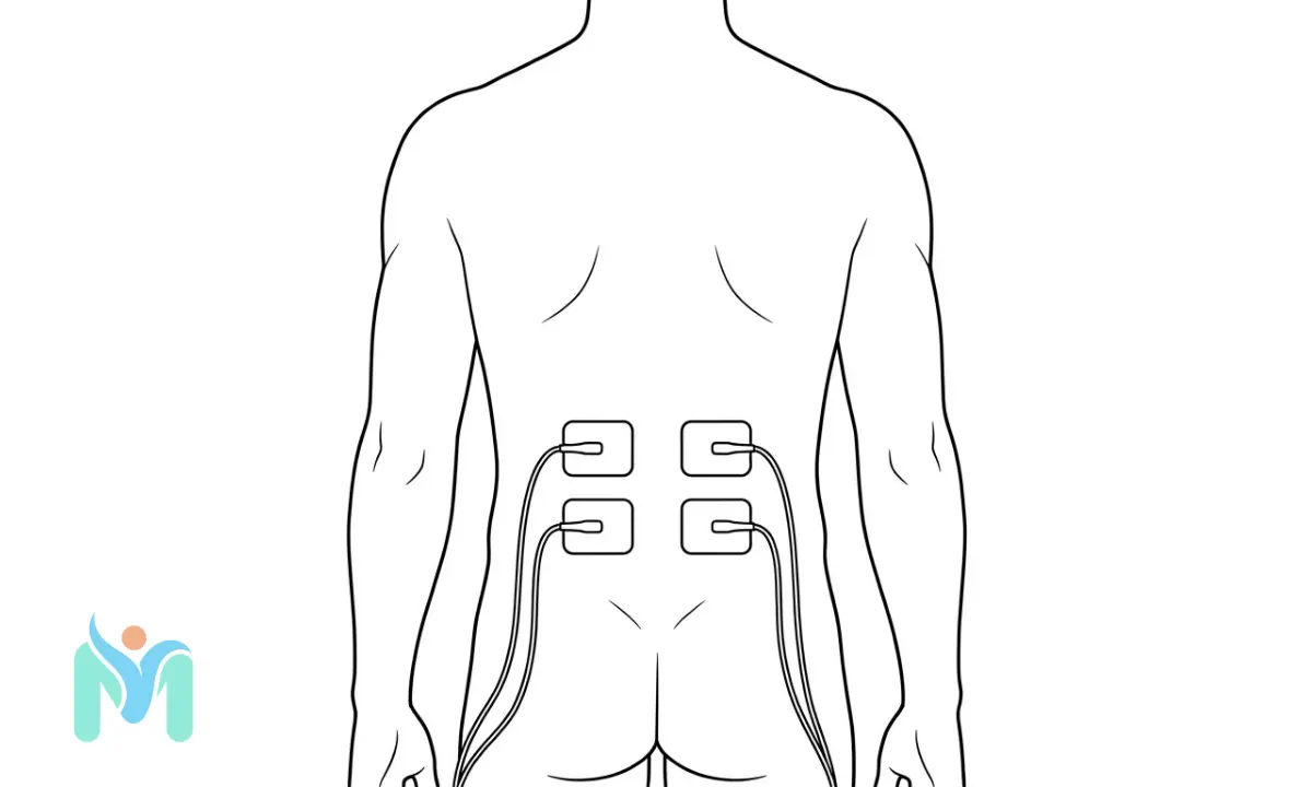 Anatomical line drawing showing 4-pad TENS unit grid placement on the lower back for lumbar pain relief, with electrodes positioned symmetrically on both sides of the lower spine.